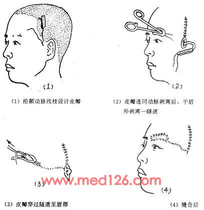 皮瓣移植