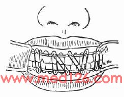 或lefert型辅助牵引,在上,下颌牙列上安装带钩的牙弓