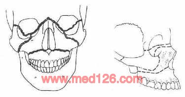 ①正面观②侧面观图8 上颌骨骨折三种类型图9 下颌骨骨折好发部位颌骨