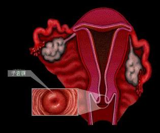 子宫下端长而狭细的部分为子宫颈,为肿瘤好发的部位