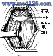 甲状腺舌管囊肿(瘘)切除术