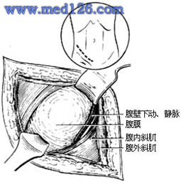 ⑴分开肌层,显露腹壁下动静脉 图3 显露下段输尿管