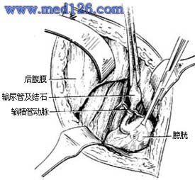 输尿管切开取石手术