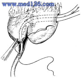 肾盂输尿管连接部成形术操作步骤,图片图谱图解,手术