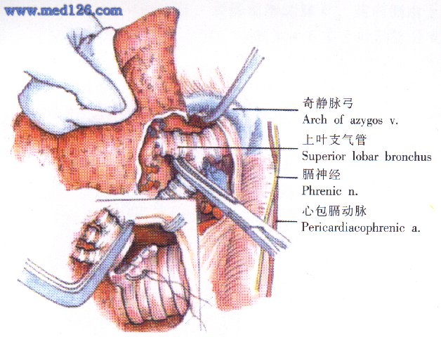 肺叶切除术操作步骤,图片图谱图解,手术治疗方法,诊断