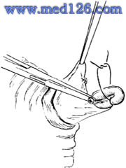 男性输精管结扎手术