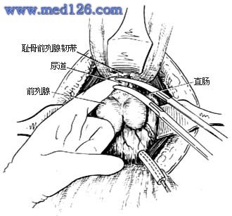 勃起功能障碍的预防和治疗图1) 治疗细菌性前列腺炎的方法有男