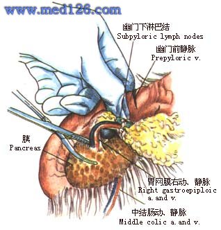 医学全在线 医学图谱 手术图谱 胃肠外科学 胃,十二指肠手术 >> 图片