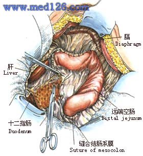 胃切除术胃全切除术