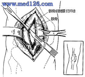 髌骨骨折切除术操作步骤,图片图谱图解,手术治疗方法