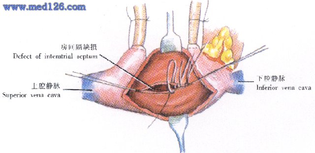 房间隔缺损修补术 repair of interatrial septal defect(彩色)