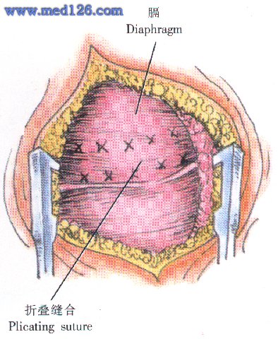 膈膨升折叠术操作步骤,图片图谱图解,手术治疗方法,诊断纵隔手术