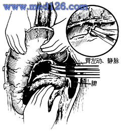 5-4 钳夹,切断,缝扎胃左动,静脉