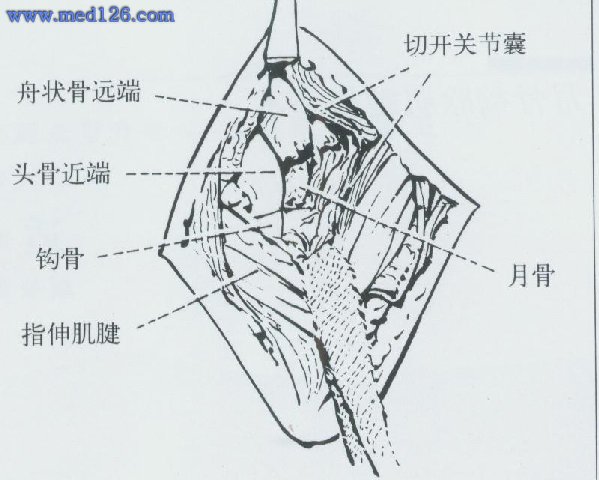 医学全在线 医学图谱 手术图谱 手外科学 骨与关节损伤的修复 > 正文