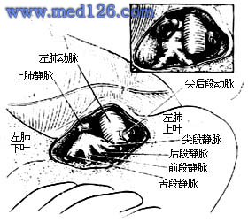 左上肺叶切除术(转载)