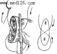 图6-8单纯结扎止血法贯穿缝合结扎止血法图6-9血管钳夹,切断,结扎图6