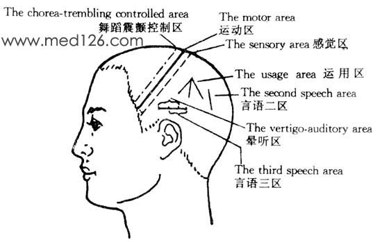 中医针灸头针疗法侧面刺激区:言语二区定位及主治
